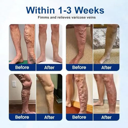 Vein Ease Microdarts Varicose Veins Treatment Patch | Amavheaf