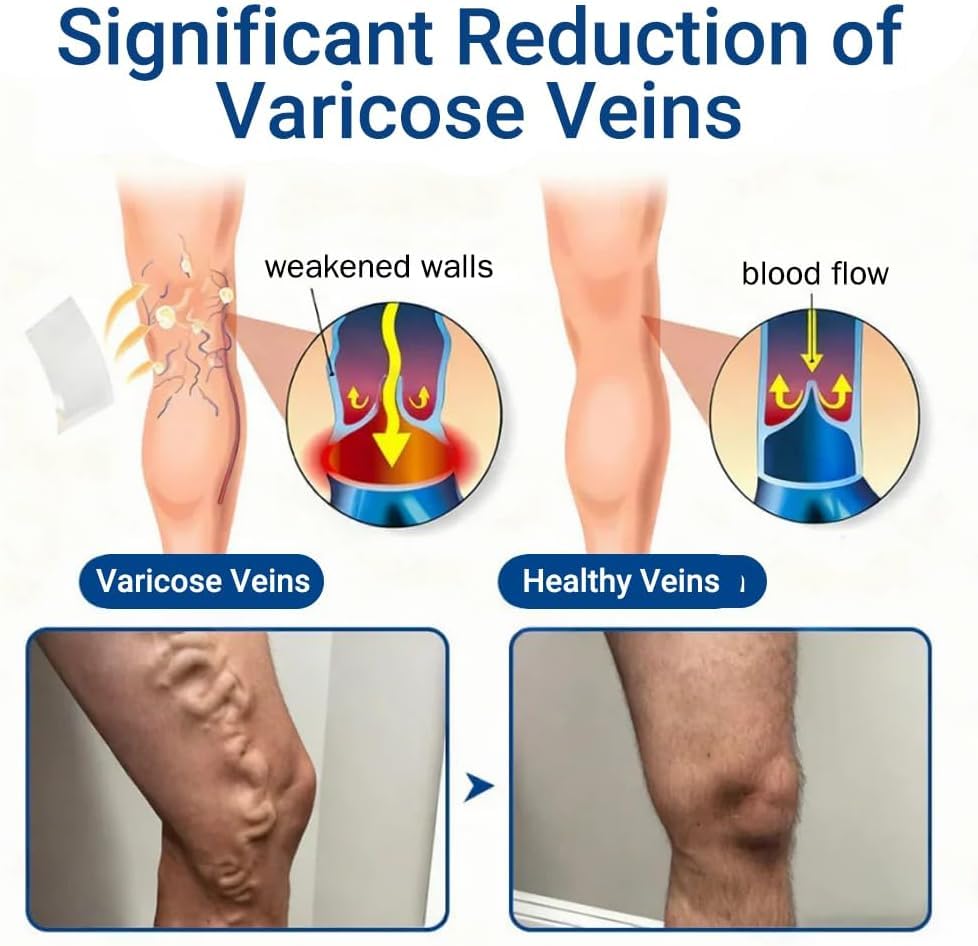 Vein Ease Microdarts Varicose Veins Treatment Patch | Amavheaf