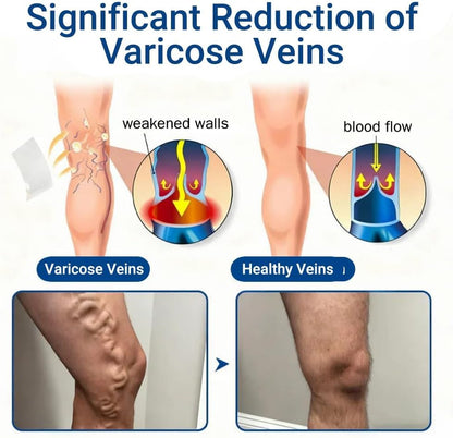 Vein Ease Microdarts Varicose Veins Treatment Patch | Amavheaf